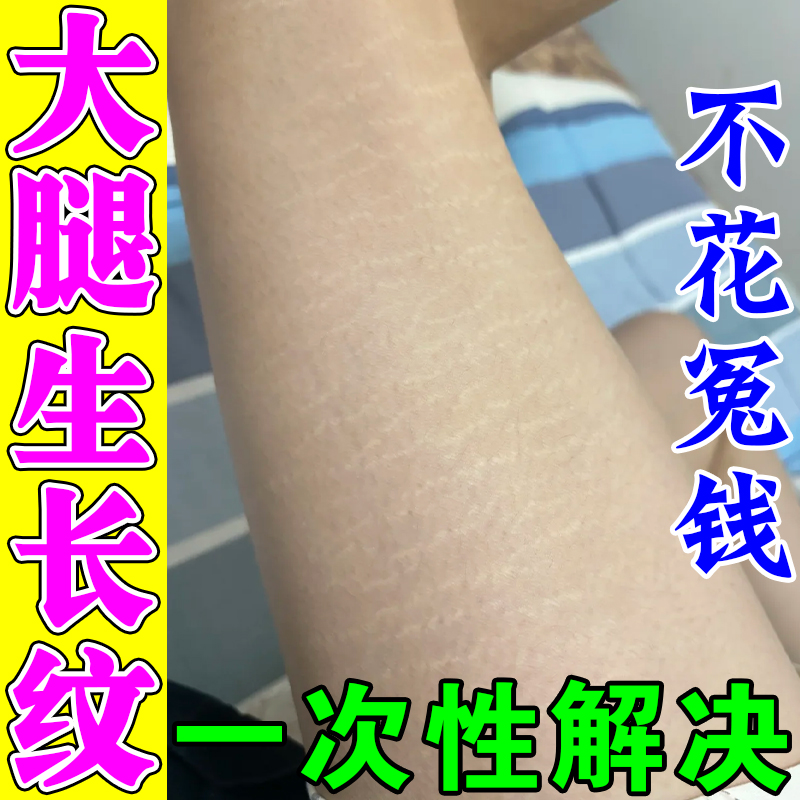 去生长纹肥胖纹修复霜消除大腿学生青少年淡化祛肥胖纹路专用药膏