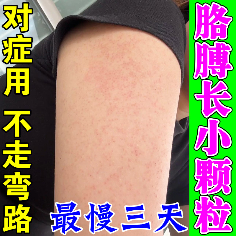 胳膊长鸡皮肤疙瘩小颗粒炎毛周囊角化去手臂红点白头小疙瘩药专用