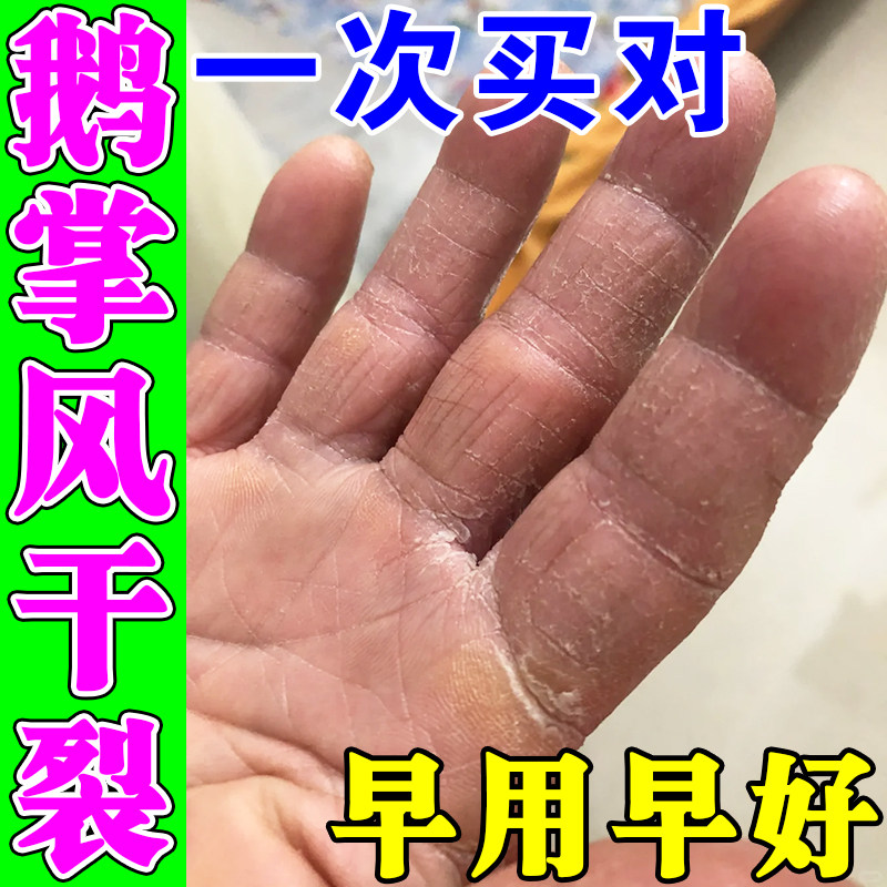 鹅掌风专用药治疗手藓手掌干裂脱皮痒手指开干裂口真菌起死皮药膏