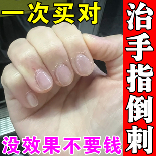 手上长倒刺修复儿童手指甲缝开裂口子干裂手脱皮干燥起皮愈合药膏