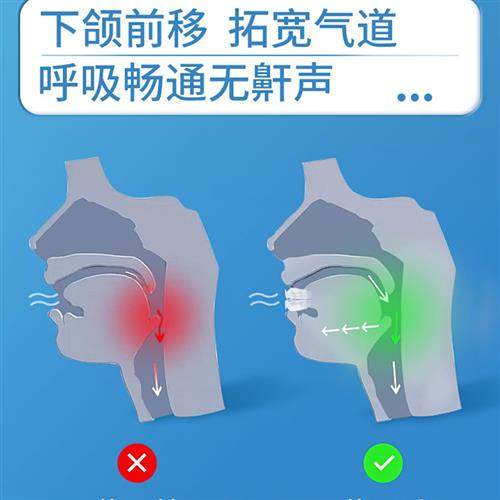 止鼾牙套神器阻止打鼾打呼噜止鼾器呼吸暂停口腔矫治器机防呼噜消