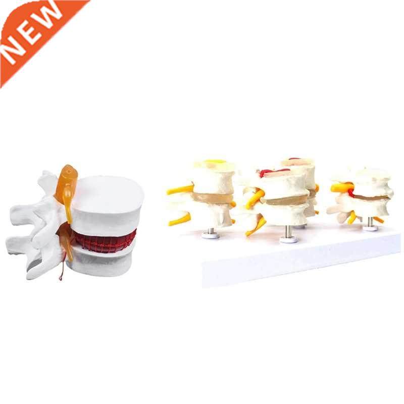1 Pcs Skeleton Spine Lumbar Disc Herniation Teaching Model &