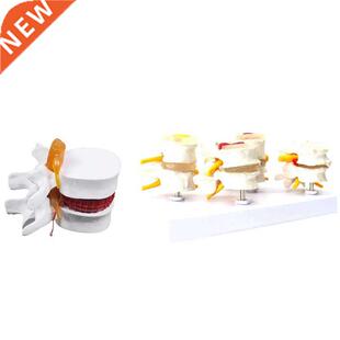 1 Pcs Skeleton Spine Lumbar Disc Herniation Teaching Model &