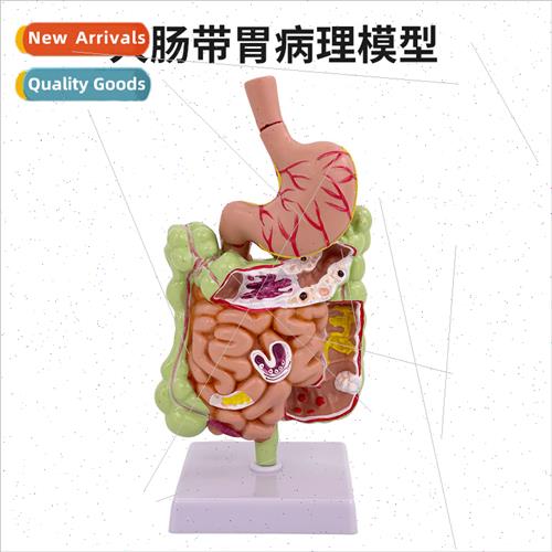 Human colon pathology model Gastrointestinal anatomy model s
