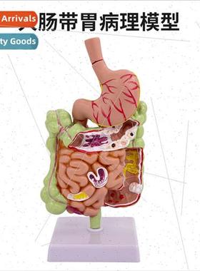 Human colon pathology model Gastrointestinal anatomy model s