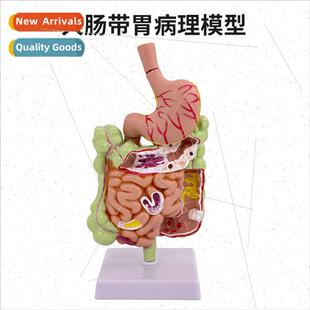 Human colon pathology model Gastrointestinal anatomy model s