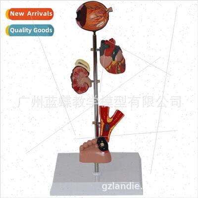 Demonstration model diabetes complications Demonstration mod