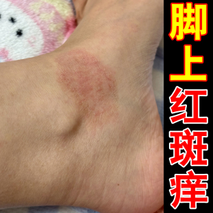 脚上红斑痒春夏天气热脚痒脚面干燥粗糙起皮屑换季脚背痒外用乳膏