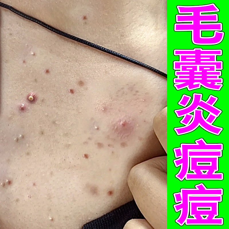 前胸后背长痘马拉色菌药后背长痘痘毛囊炎脓包起红疙瘩痒螨虫痘膏
