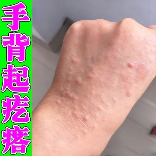 手背痒手上长小疙瘩起皮汗状手痒药手背小颗粒痒软膏