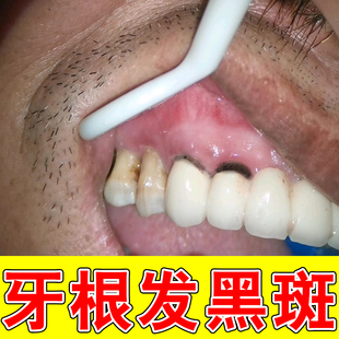 牙根发黑牙菌斑神器牙齿牙根牙缝长黑斑牙黄牙黑牙垢清除神器