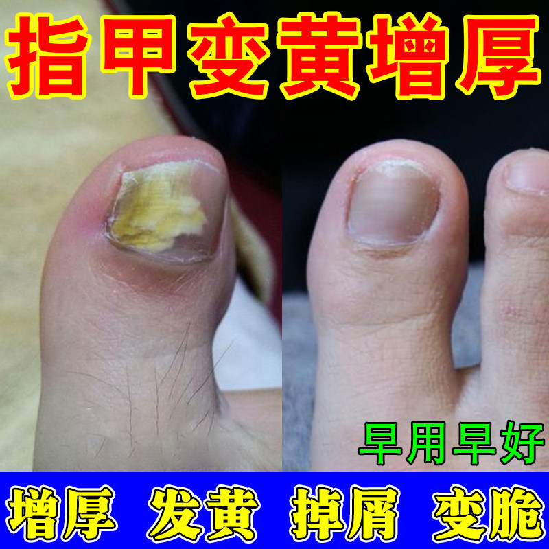 脚指甲坏指甲增厚脚趾甲增厚变脆空甲修复甲床分离液