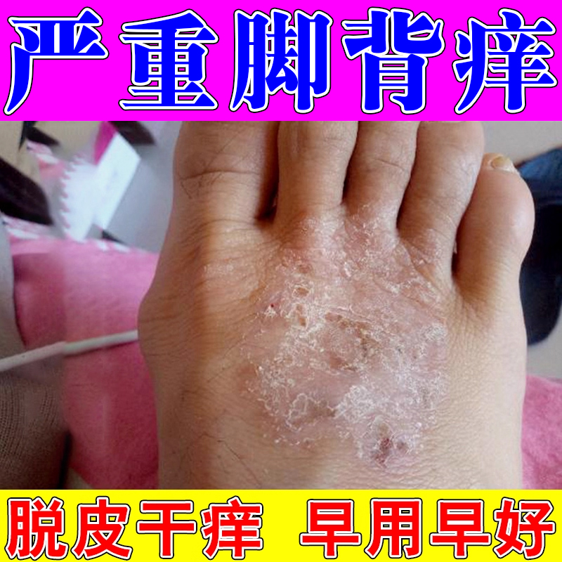 脚背红斑干裂痒秋冬季天冷脚面皮肤干燥粗糙脱皮脚痒水泡蜕皮喷雾