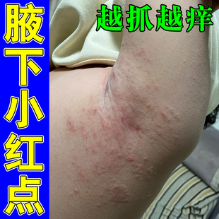 腋下长小点身上腋窝痒起小颗粒疙瘩胳肢窝膏