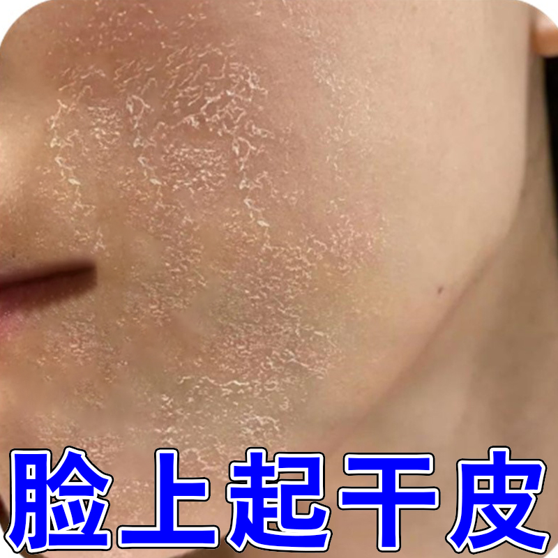 脸上干燥起皮脸干皮脱皮干痒秋冬天冷脸部掉皮发痒皮肤粗糙起干皮