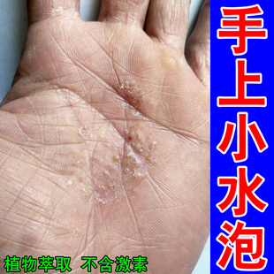 手掌痒刺痒手上脓包手蜕皮燥粗糙手起皮掉皮痒外用软膏