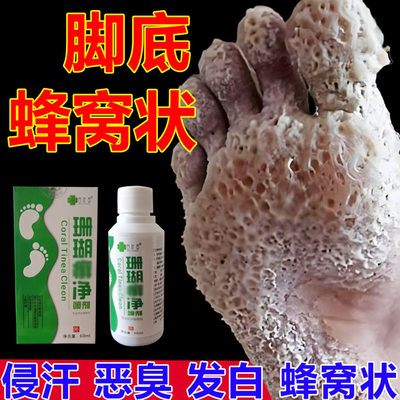 窝状角质松解症药脚底起泡蜂窝状沙虫脚出汗脚痒臭脚脚底发白脚臭
