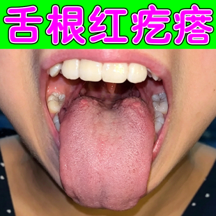 舌根部红疙瘩喉咙滤泡吞咽有异物感外用喷雾剂