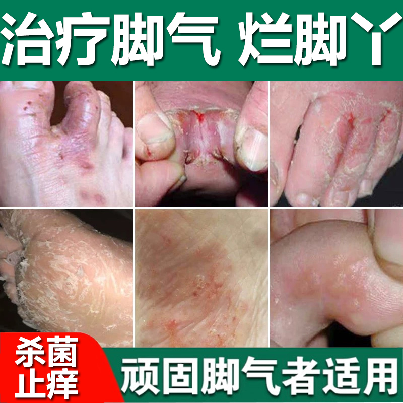 【仁和】盐酸特比萘芬乳膏1%*10g*1支/盒