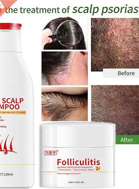 Hair Psoriasis Seborrheic Skin Care Treatment Dermatitis Ecz