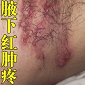 腋下红肿疼腋下胳肢窝出汗发臭异味腋窝湿长小疙瘩乳膏
