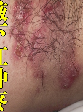 腋下红肿疼腋下胳肢窝出汗发臭异味腋窝湿痒皮肤痒长小疙瘩乳膏