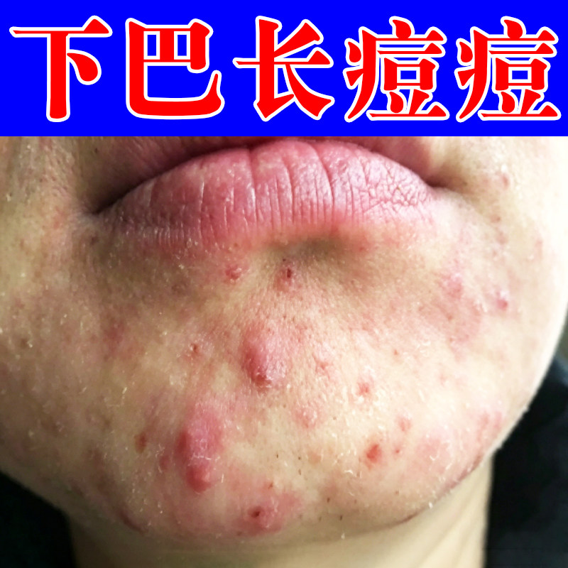 下巴红痘痘脓包疙瘩脸上额头青春皮肤消毒护理（消）