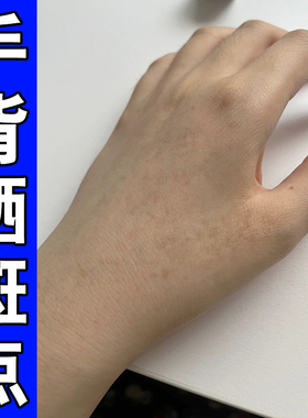 手被日晒黑斑手上长老年斑手背晒黑斑黄褐斑黑斑点黑色素沉淀专用