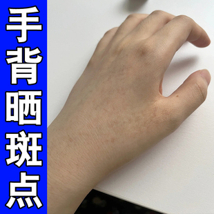 手被日晒黑斑手上长老年斑手背晒黑斑黄褐斑黑斑点黑色素沉淀专用