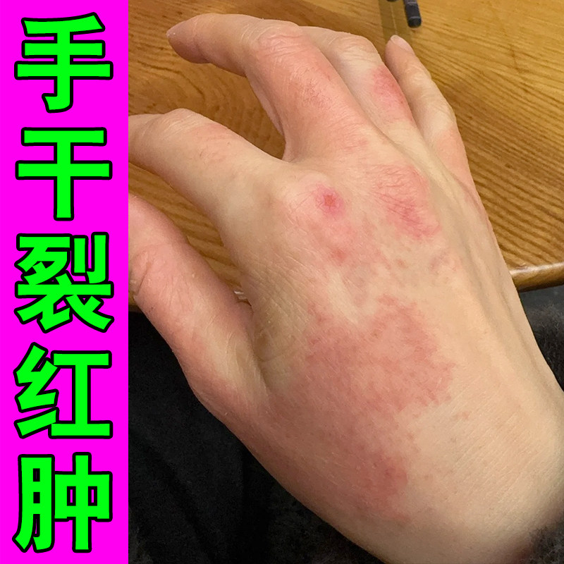 冻疮膏手指冻伤膏冬天手足耳朵冻伤红肿疼防冻裂手背干裂手皴,保健用品,皮肤消毒护理（消）,淘宝优惠券,粉丝福利购,淘宝优惠卷
