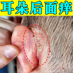 耳朵后面干燥起皮红刺挠外耳道起皮屑掉皮专用膏
