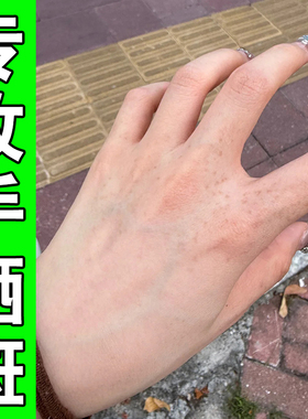 手背上的老年斑日晒黑斑手部脸部长黑色斑点黄褐斑脸上褐色斑点膏