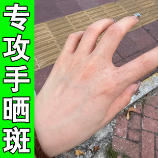 手背上的老年斑日晒黑斑手部脸部长黑色斑点黄褐斑脸上褐色斑点膏