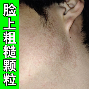 小孩脸上有小颗粒起小疙瘩毛囊红斑黑变病膏
