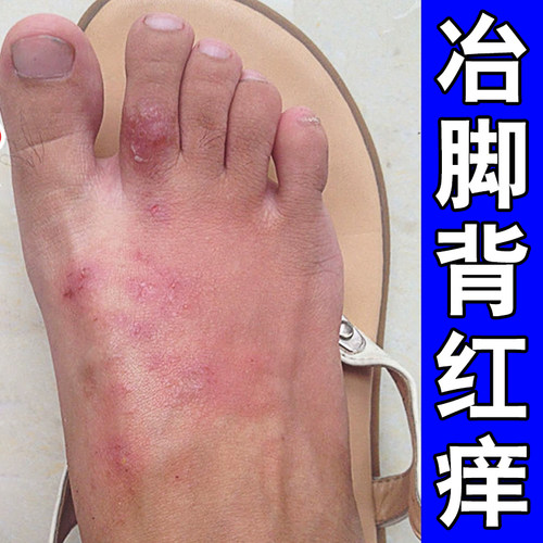 脚背脚趾头关节上蜕皮脚面干燥起皮去红点红斑喷剂