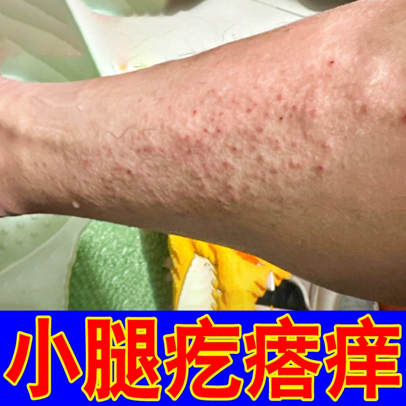 冬天冷小腿腿上干燥起皮换季腿上起红点疙瘩,保健用品,皮肤消毒护理（消）,淘宝优惠券,粉丝福利购,淘宝优惠卷