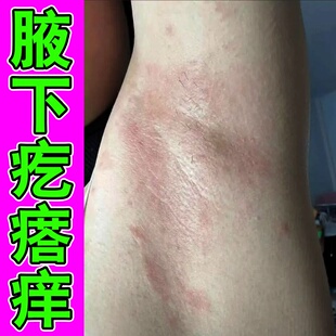 腋下淹了红肿刺痛胖人出汗多胳肢窝淹红痒有味臭腋窝红肿