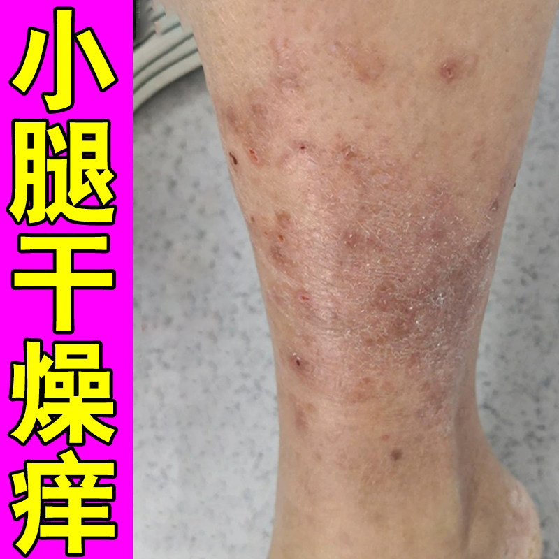 冬天天气冷小腿干燥儿童腿部身上腿上起红点疙瘩膏,保健用品,皮肤消毒护理（消）,淘宝优惠券,粉丝福利购,淘宝优惠卷