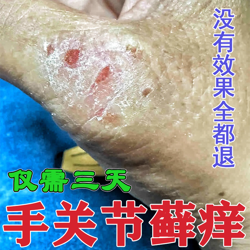 手指关节长癣大拇指脱皮干裂瘙痒手癣藓硬疙瘩真菌感染手痒专用药