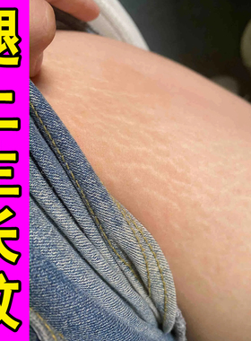 去肥胖纹修复霜生长纹大腿学生去除男淡化纹路去肥胖纹膏