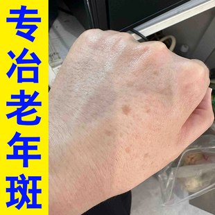 手部老年斑手背脸上日晒黑斑黄褐斑黑斑老年斑脸上手背上专用乳膏