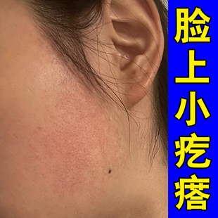 脸上起小疙瘩脸颊两侧小颗粒颈部毛囊红斑黑变病闭口粉刺