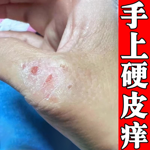 手痒起皮膏手指蜕皮裂开裂口手指关节起硬皮掉皮手痒痒外用药