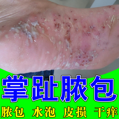 掌跖脓包症脚底起水泡干痒手指脱皮干燥粗糙起皮屑痒皮损掌趾脓包