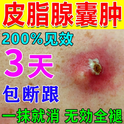 皮脂腺囊肿膏去皮下囊肿粉瘤脓包痤疮拔脓膏火疖子拔毒神器药