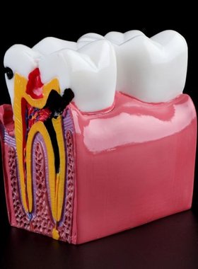 6 Times Dental Caries Comparation Anatomy Teeth Model for De