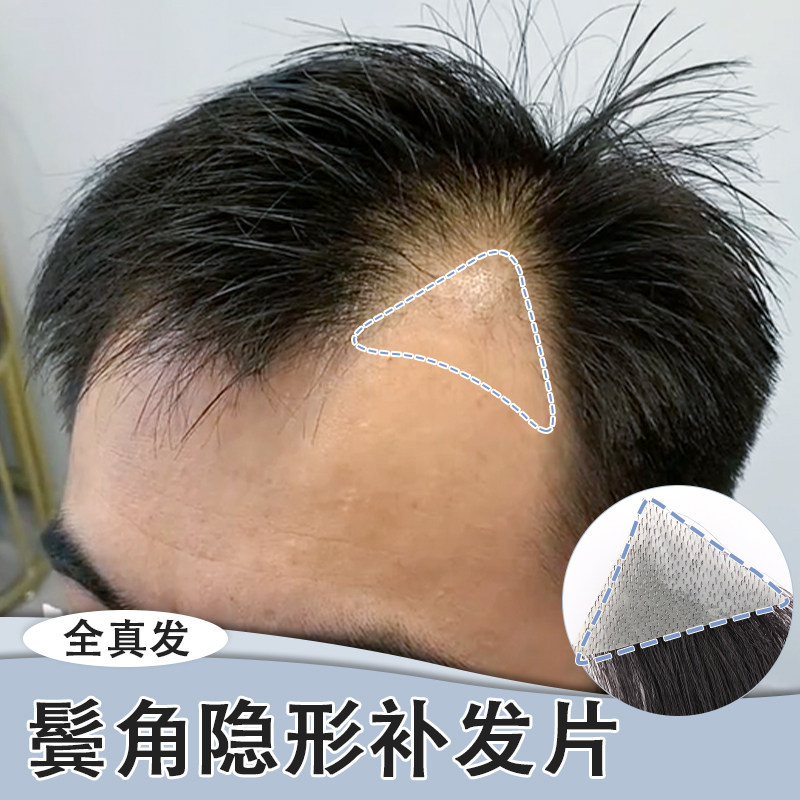 鬓角补发贴隐形无痕假发片全真人发m型前额补发片浏海片男女同用
