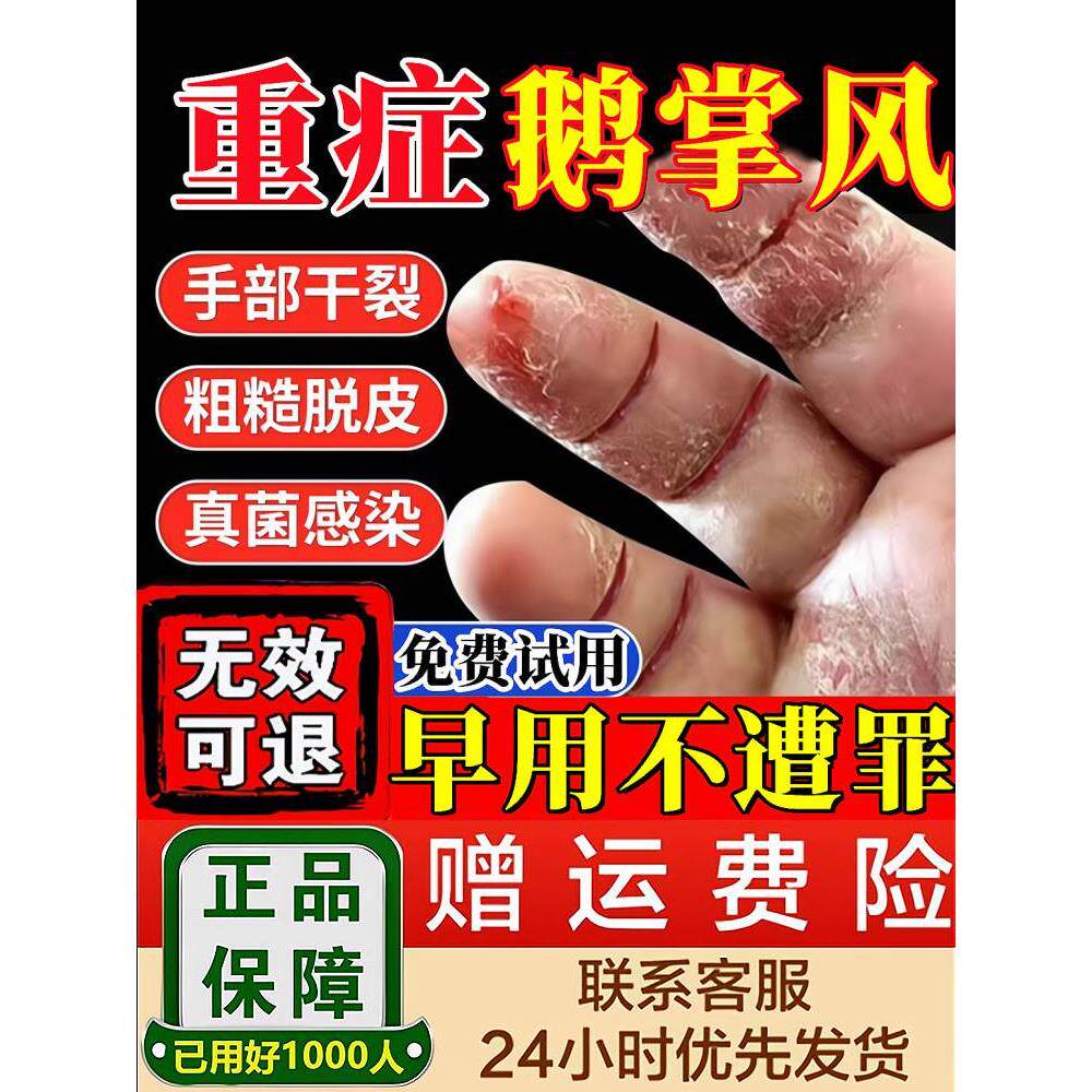 治疗鹅掌风手掌干裂脱皮止痒抑菌膏手癣真菌感染烂手专用特药膏