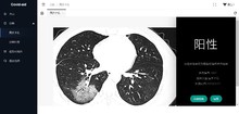 DL00656-基于医学图像传染病辅助诊断研究与流行范围可视化系统