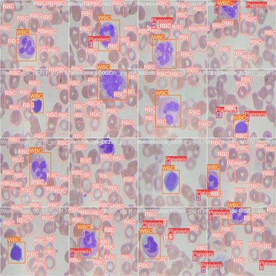 基于YOLOv8的血细胞检测cancer cell  detection源码含数据集
